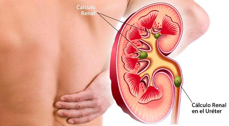 Imagen de Cálculos renales (Litiasis renal)