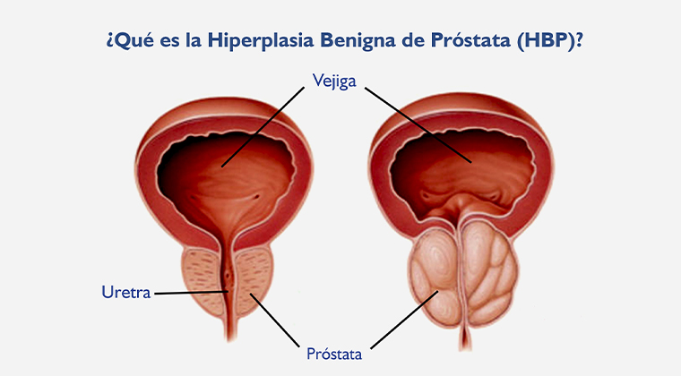 Imagen de Hiperplasia benigna de próstata (HBP)